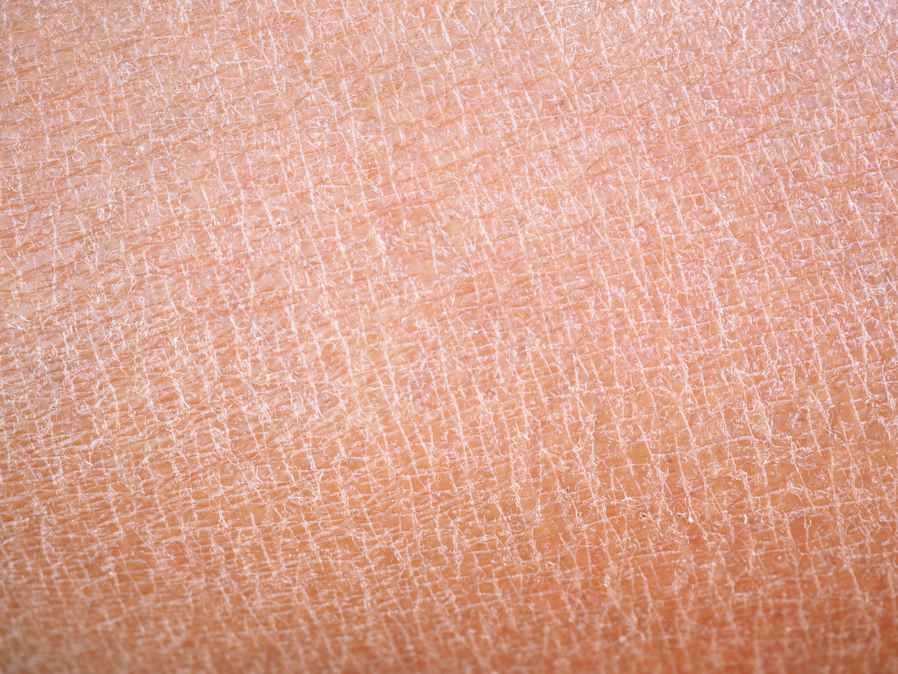 Skóra sucha lub bardzo sucha